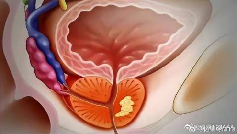 前列腺炎最新疗法,前列腺炎最新疗法，探索与突破