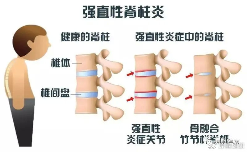 强直性脊柱炎最新进展,强直性脊柱炎最新进展研究综述