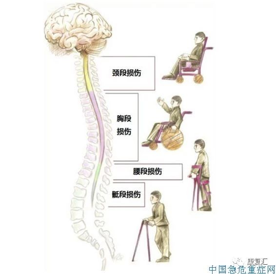 全球脊髓损伤最新进展,全球脊髓损伤最新进展